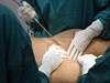 První změny ve tvaru postavy poznáte už po týdnu, ale definitivně se výsledek liposukce projeví až po čtyřech šesti týdnech. | na serveru Lidovky.cz | aktuální zprávy První změny ve tvaru postavy poznáte už po týdnu, ale definitivně se výsledek liposukce projeví až po čtyřech šesti týdnech. | na serveru Lidovky.cz | aktuální zprávy