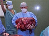 Nádor vážící 36 kg mohl v těle ženy ze Zlínska růst i čtyři roky. | na serveru Lidovky.cz | aktuální zprávy Nádor vážící 36 kg mohl v těle ženy ze Zlínska růst i čtyři roky. | na serveru Lidovky.cz | aktuální zprávy